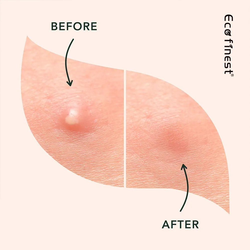 Miracle Pimple Patches 2 sizes, Invisible Spot Cover - Hydrocolloid Acne Patch for Face, Blemishes, Zits Absorbing Patch, Breakouts Spot Treatment for Skin Care, Facial Sticker 2 Size (36 Count) - HARMONIFY - Miracle Pimple Patches 2 sizes, Invisible Spot Cover - Hydrocolloid Acne Patch for Face, Blemishes, Zits Absorbing Patch, Breakouts Spot Treatment for Skin Care, Facial Sticker 2 Size (36 Count) - HARMONIFY - Miracle Pimple Patches 2 sizes, Invisible Spot Cover - Hydrocolloid Acne Patch for